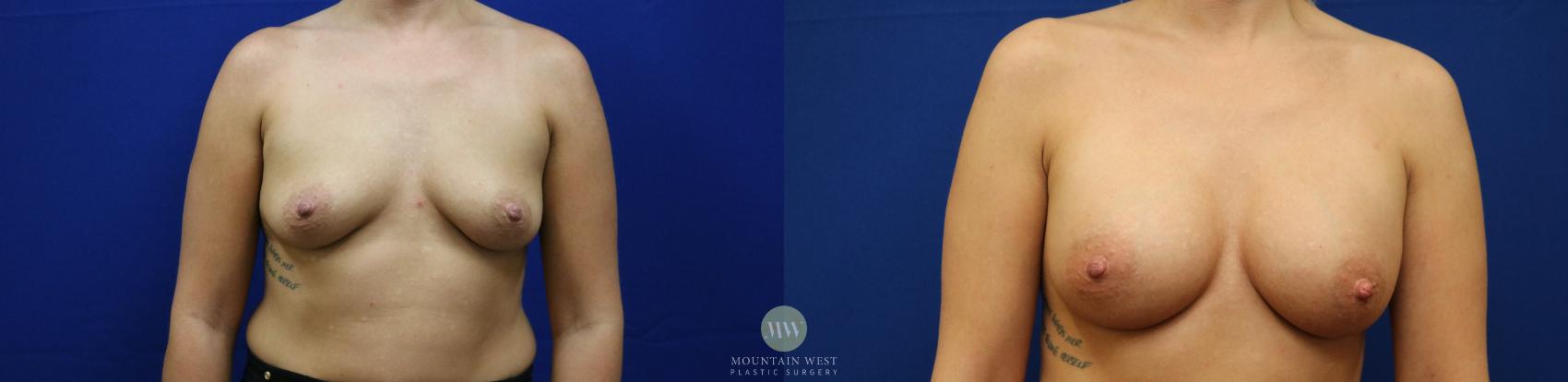 Before & After Breast Augmentation Case 134 Front View in Kalispell, MT