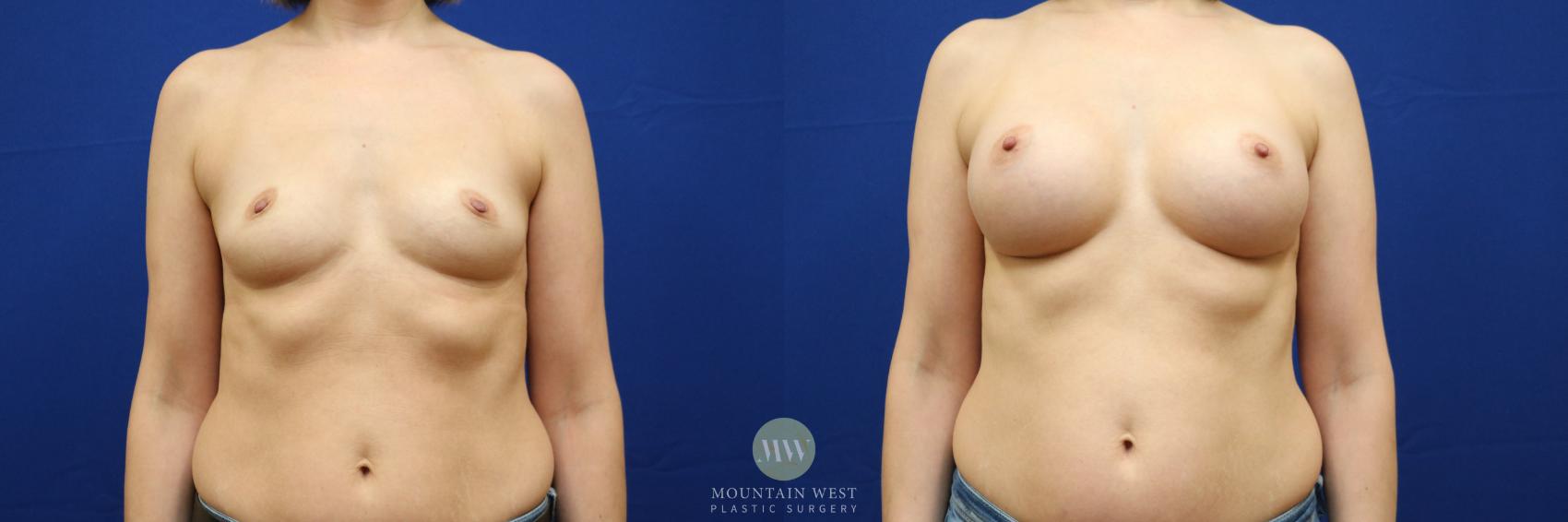 Before & After Breast Augmentation Case 135 Front View in Kalispell, MT