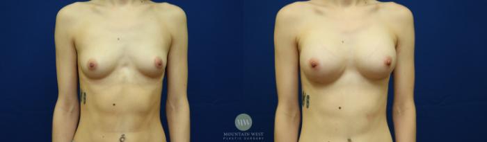 Before & After Breast Augmentation Case 138 Front View in Kalispell, MT