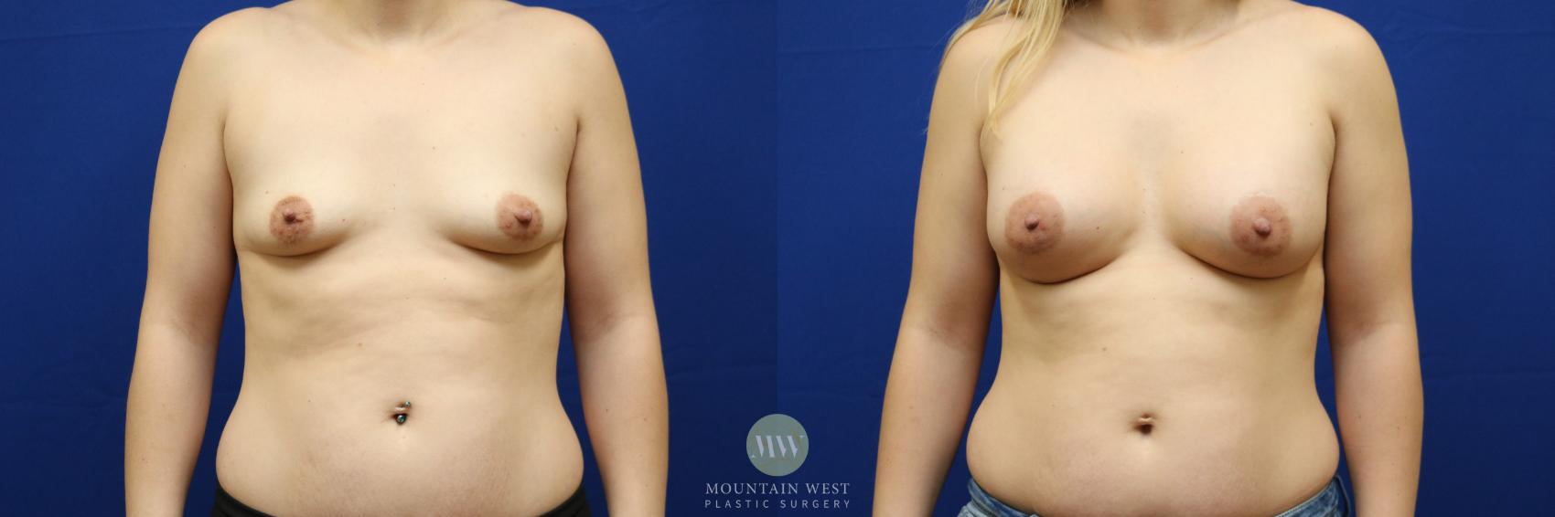 Before & After Breast Augmentation Case 139 Front View in Kalispell, MT