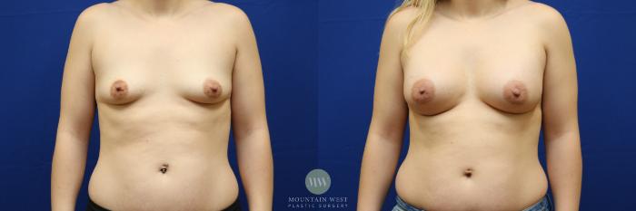 Before & After Breast Augmentation Case 139 Front View in Kalispell, MT