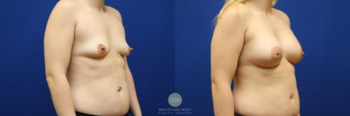 Before & After Breast Augmentation Case 139 Right Oblique View in Kalispell, MT