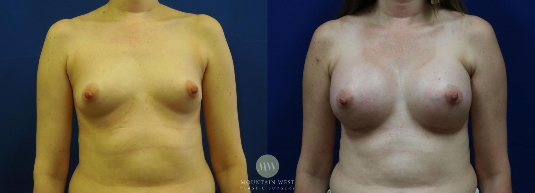 Breast Augmentation Case 14 Before & After View #1 | Kalispell, MT | Mountain West Plastic Surgery
