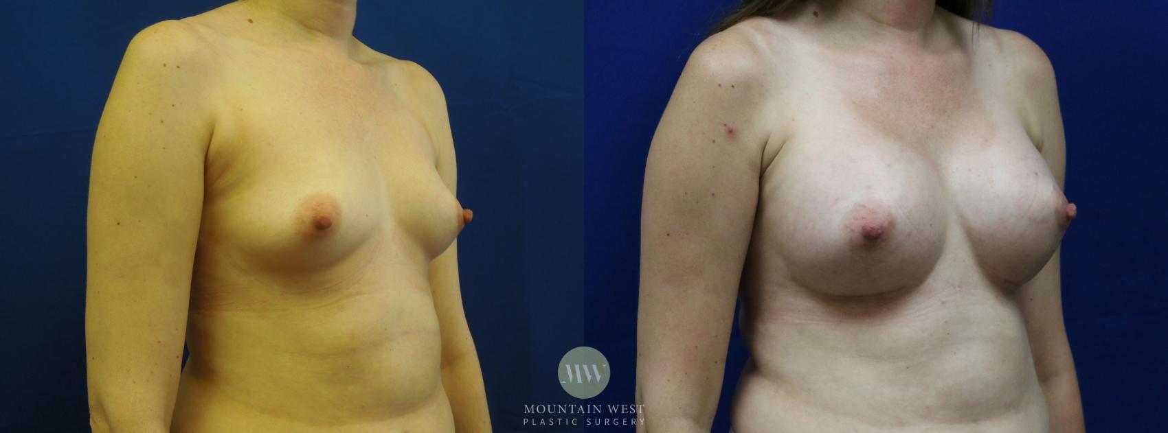 Breast Augmentation Case 14 Before & After View #2 | Kalispell, MT | Mountain West Plastic Surgery
