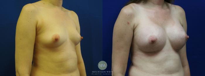 Before & After Breast Augmentation Case 14 View #2 View in Kalispell, MT