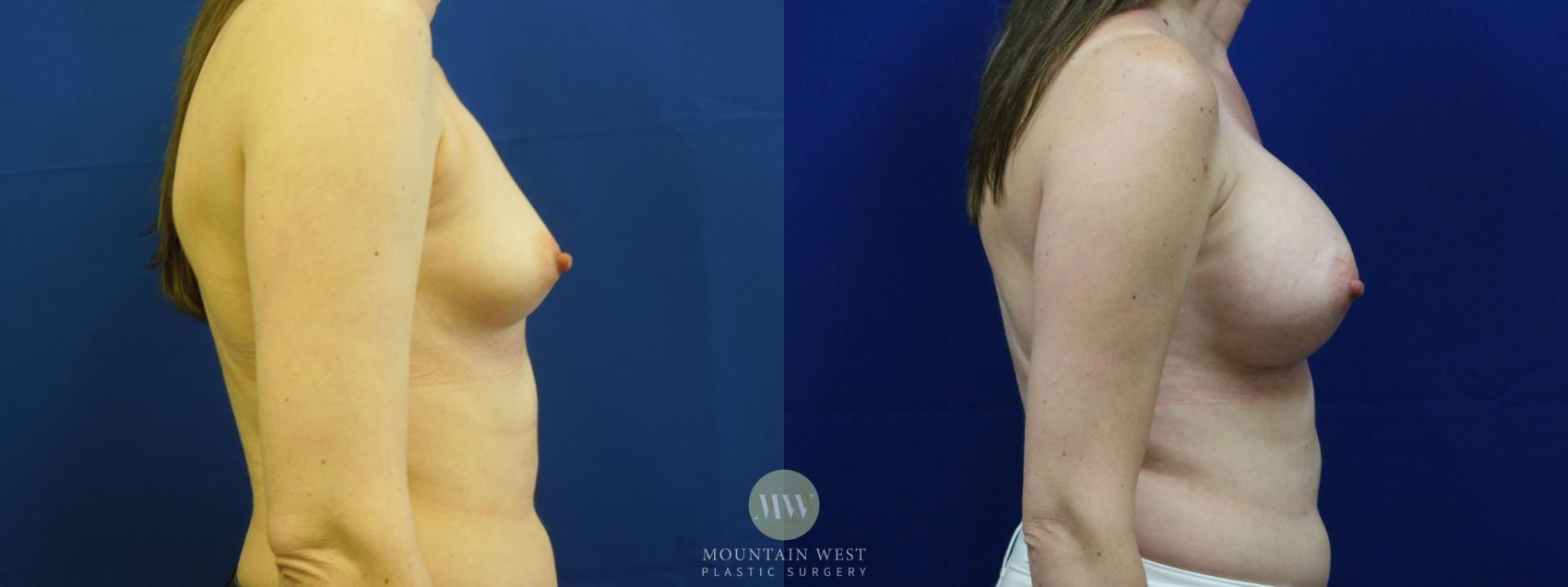 Breast Augmentation Case 14 Before & After View #3 | Kalispell, MT | Mountain West Plastic Surgery