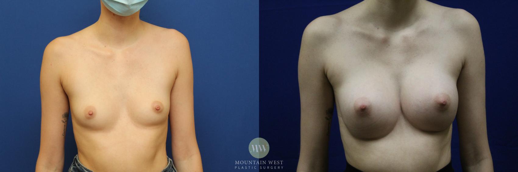 Breast Reconstruction Case 140 Before & After Front | Kalispell, MT | Mountain West Plastic Surgery