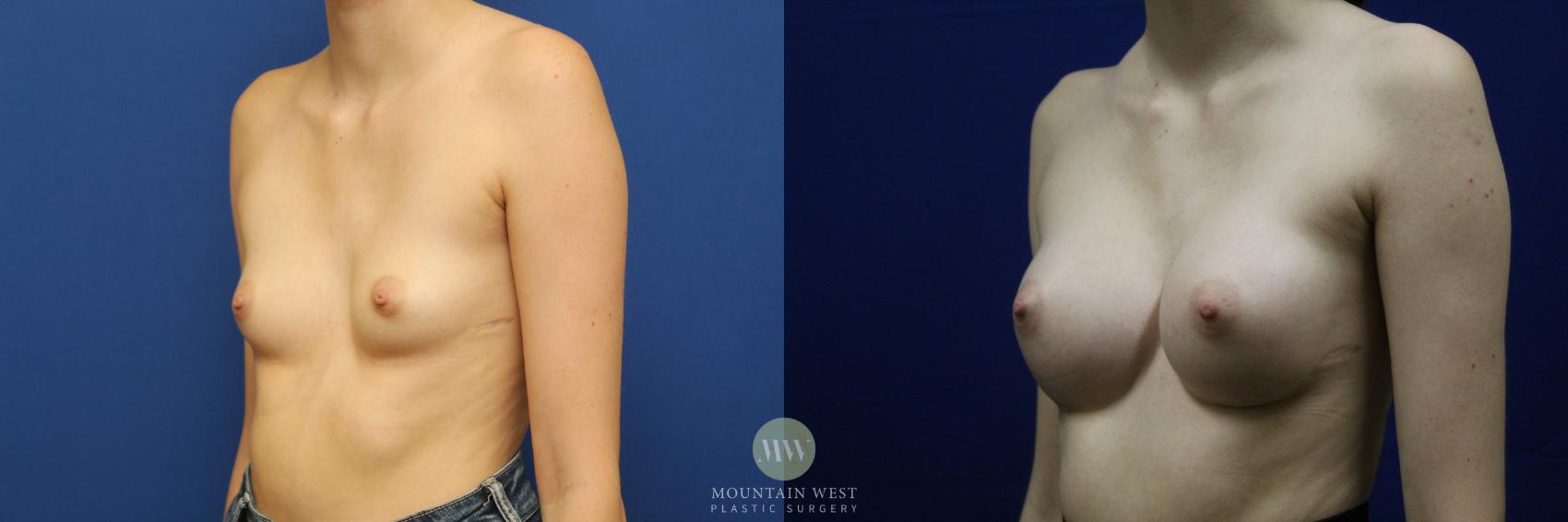 Breast Augmentation Case 140 Before & After Left Oblique | Kalispell, MT | Mountain West Plastic Surgery