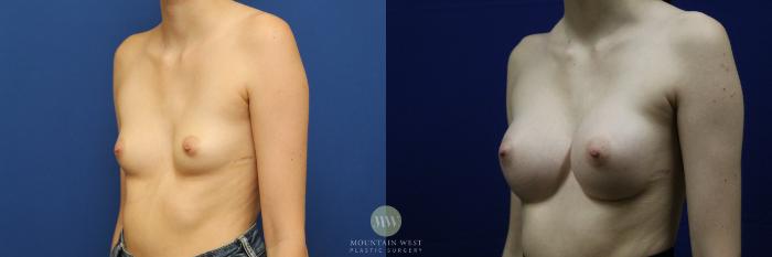 Before & After Breast Augmentation Case 140 Left Oblique View in Kalispell, MT