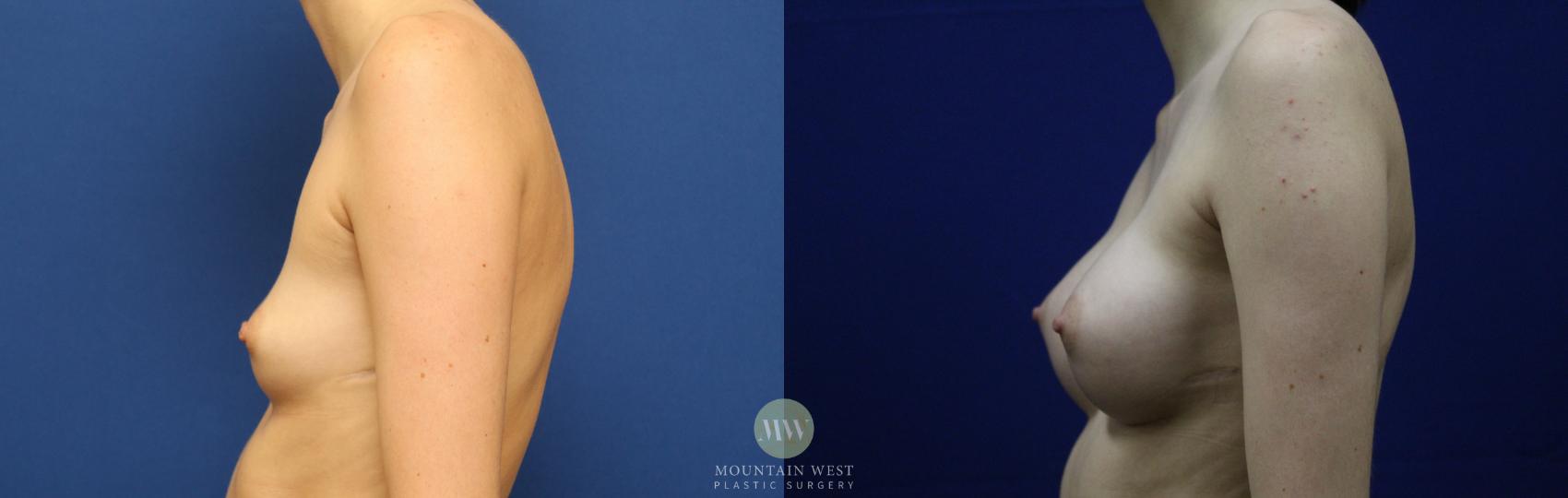 Breast Augmentation Case 140 Before & After Left Side | Kalispell, MT | Mountain West Plastic Surgery