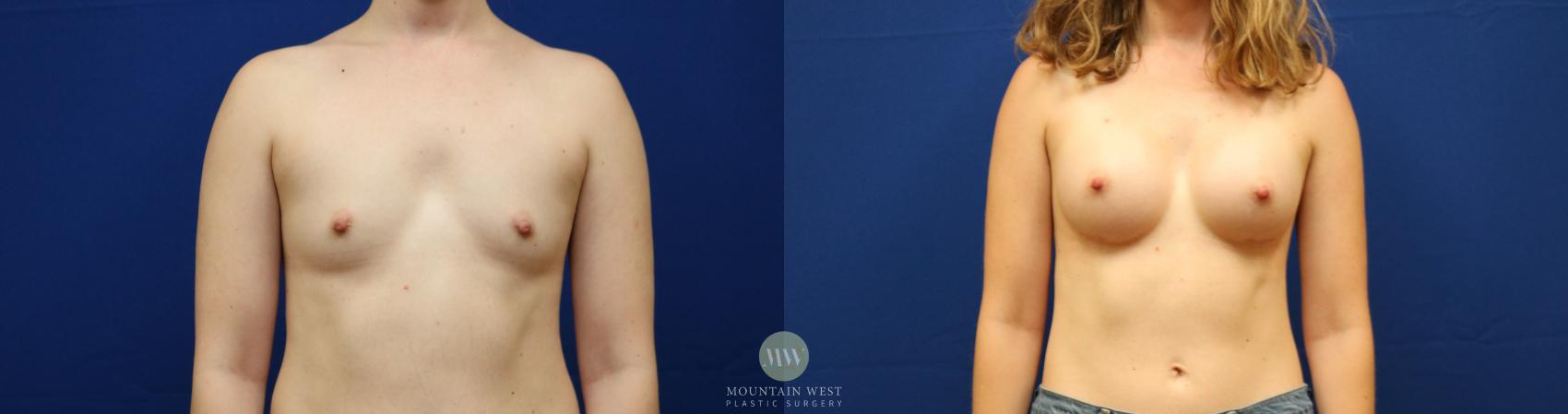 Before & After Breast Augmentation Case 148 Front View in Kalispell, MT