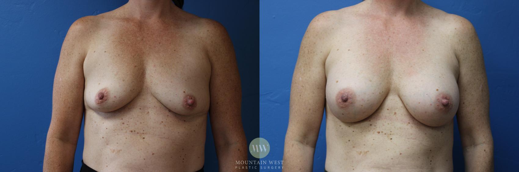 Before & After Breast Augmentation Case 151 Front View in Kalispell, MT