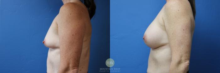 Before & After Breast Augmentation Case 151 Left Side View in Kalispell, MT