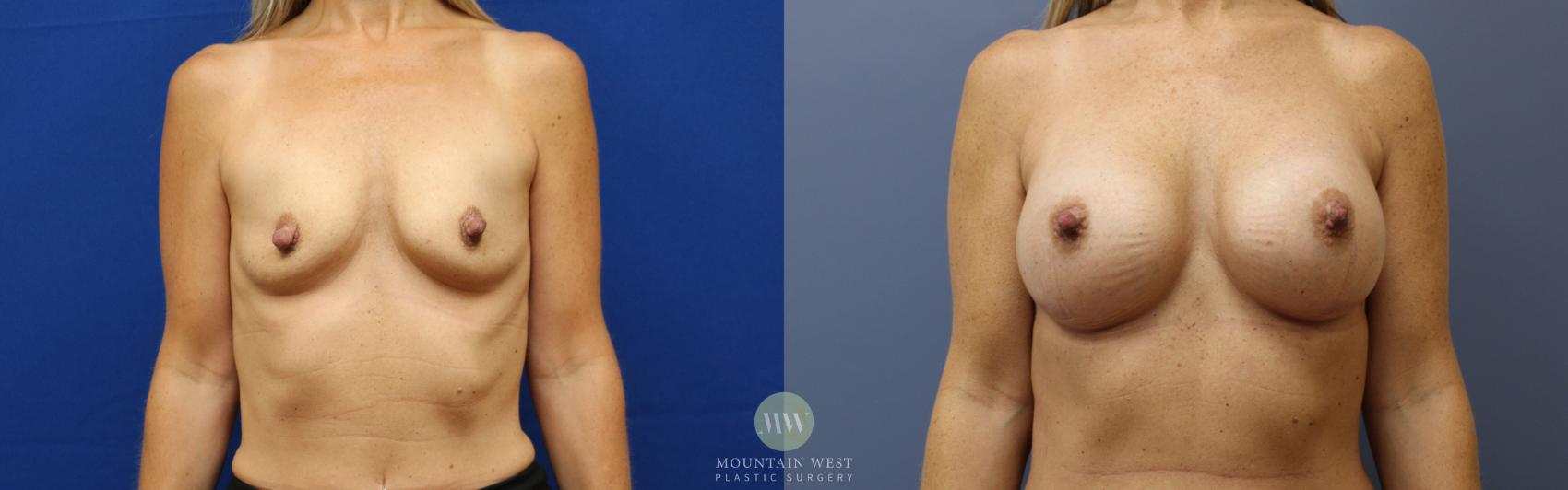 Before & After Breast Augmentation Case 155 Front View in Kalispell, MT