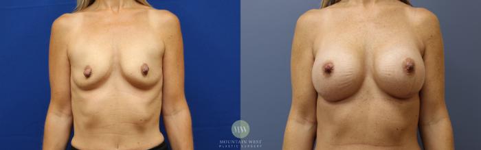 Before & After Breast Augmentation Case 155 Front View in Kalispell, MT