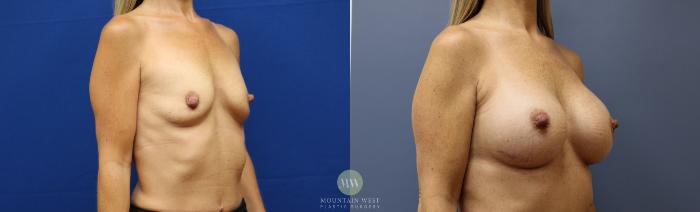 Before & After Breast Augmentation Case 155 Right Oblique View in Kalispell, MT