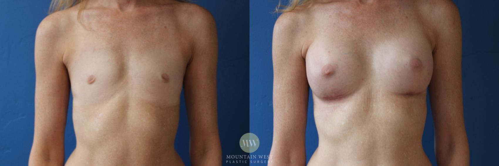 Before & After Breast Augmentation Case 159 Front View in Kalispell, MT