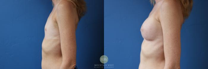 Before & After Breast Augmentation Case 159 Left Side View in Kalispell, MT