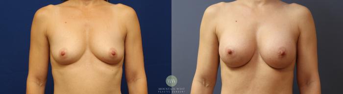 Before & After Breast Augmentation Case 162 Front View in Kalispell, MT