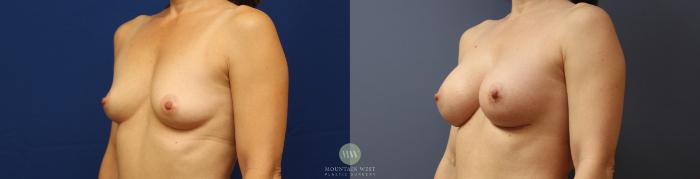 Before & After Breast Augmentation Case 162 Left Oblique View in Kalispell, MT