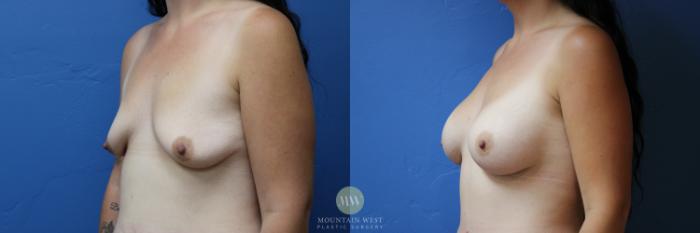 Before & After Breast Augmentation Case 169 Left Oblique View in Kalispell, MT