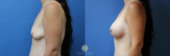 Before & After Breast Augmentation Case 169 Left Side View in Kalispell, MT