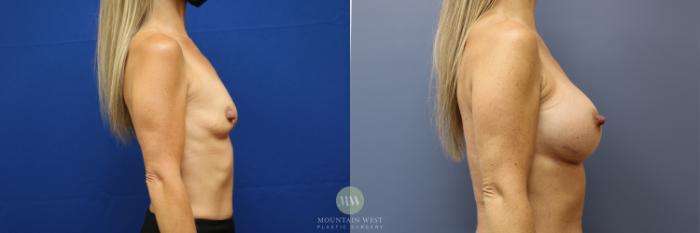 Before & After Breast Augmentation Case 172 Right Side View in Kalispell, MT