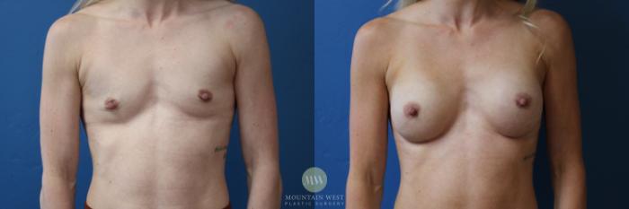 Before & After Breast Augmentation Case 176 Front View in Kalispell, MT