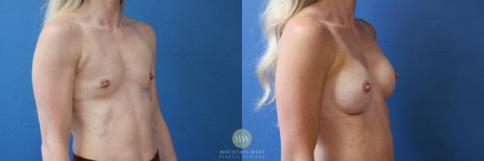 Before & After Breast Augmentation Case 176 Right Oblique View in Kalispell, MT