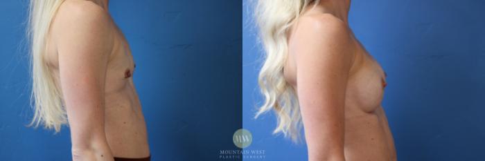 Before & After Breast Augmentation Case 176 Right Side View in Kalispell, MT