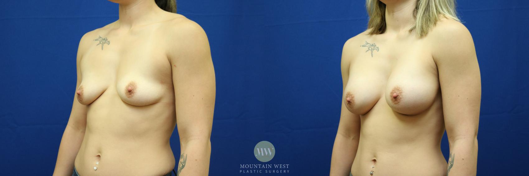 Before & After Breast Augmentation Case 18 View #1 View in Kalispell, MT