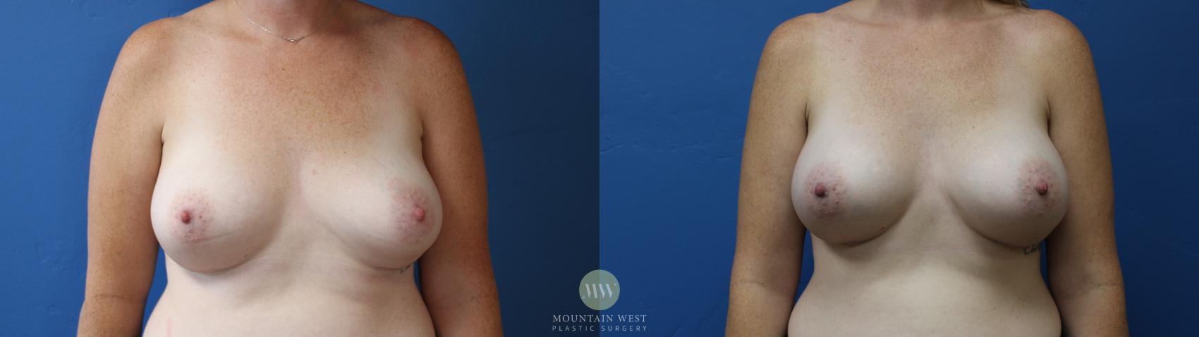 Before & After Breast Augmentation Case 187 Front View in Kalispell, MT