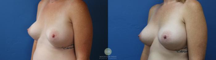 Before & After Breast Augmentation Case 187 Left Oblique View in Kalispell, MT