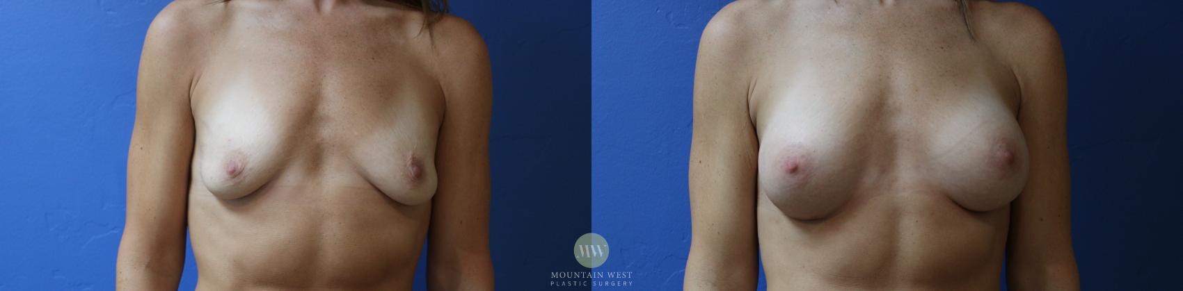 Before & After Breast Augmentation Case 188 Front View in Kalispell, MT