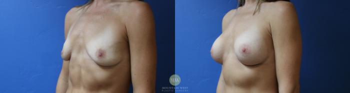 Before & After Breast Augmentation Case 188 Left Oblique View in Kalispell, MT