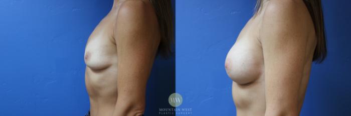 Before & After Breast Augmentation Case 188 Left Side View in Kalispell, MT