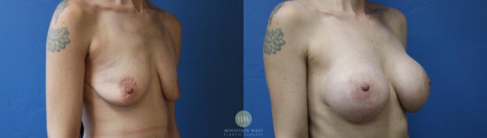 Before & After Breast Augmentation Case 193 Right Oblique View in Kalispell, MT