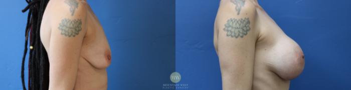 Before & After Breast Augmentation Case 193 Right Side View in Kalispell, MT