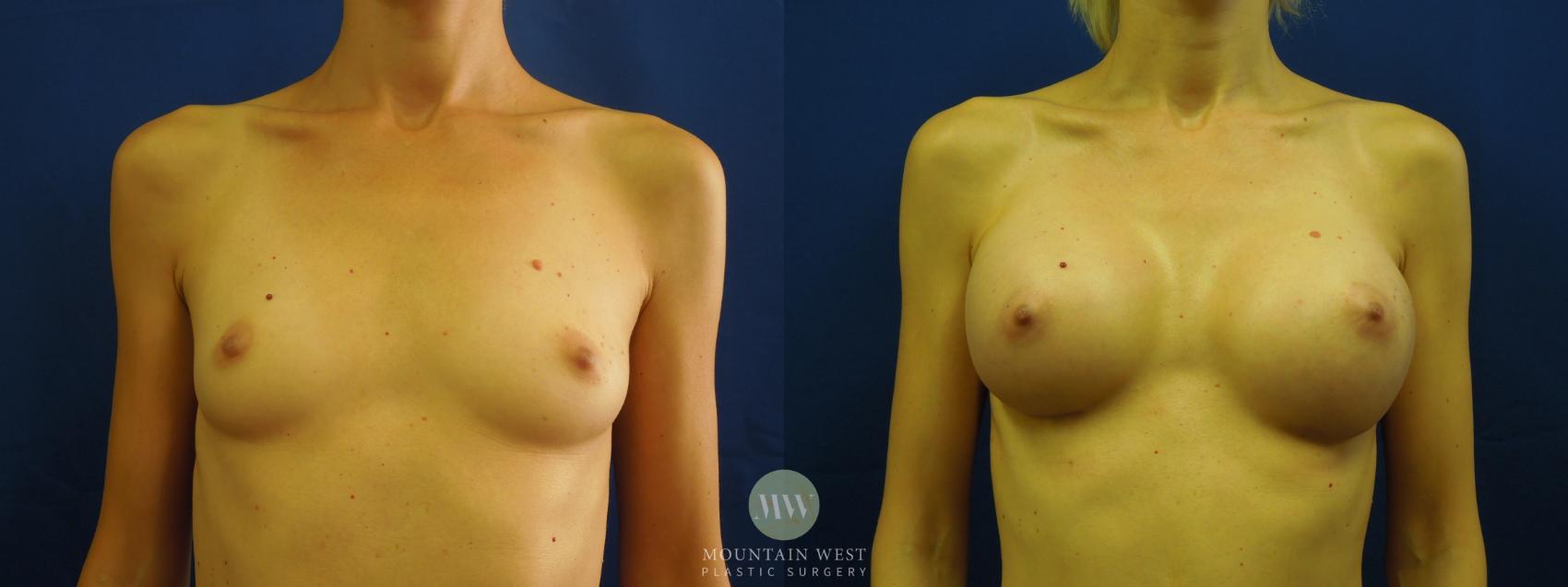 Breast Augmentation Case 20 Before & After View #1 | Kalispell, MT | Mountain West Plastic Surgery