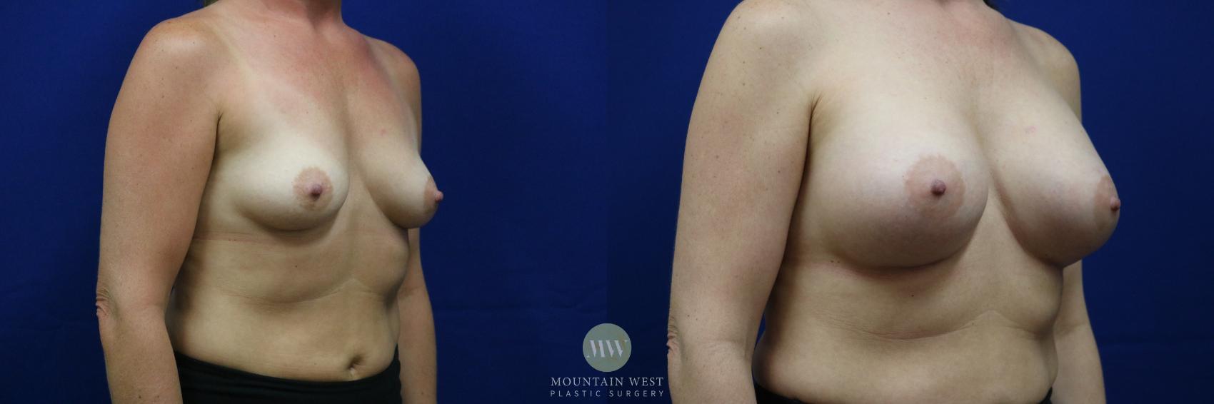 Before & After Breast Augmentation Case 22 View #1 View in Kalispell, MT