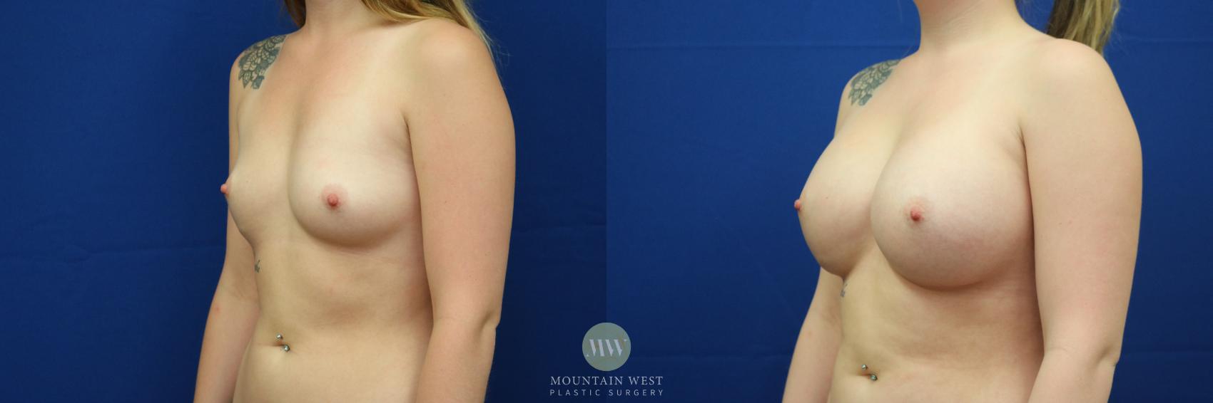 Breast Augmentation Case 23 Before & After View #1 | Kalispell, MT | Mountain West Plastic Surgery
