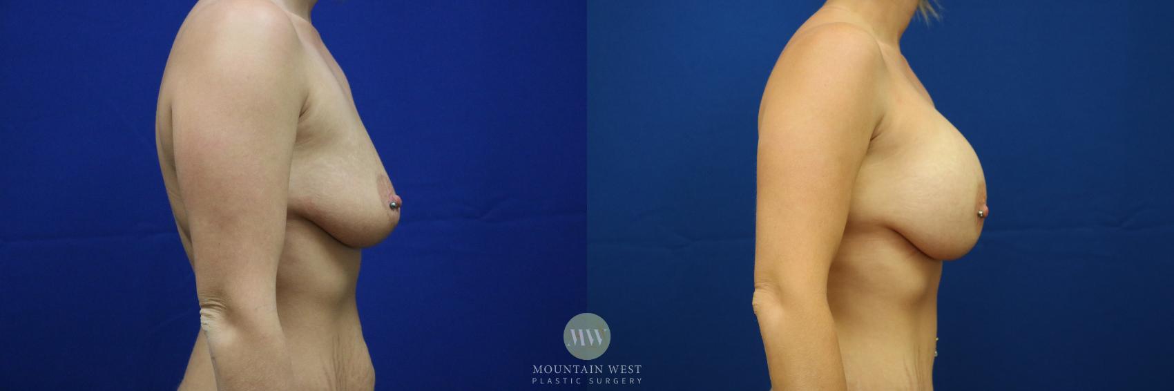 Before & After Breast Augmentation Case 25 View #1 View in Kalispell, MT