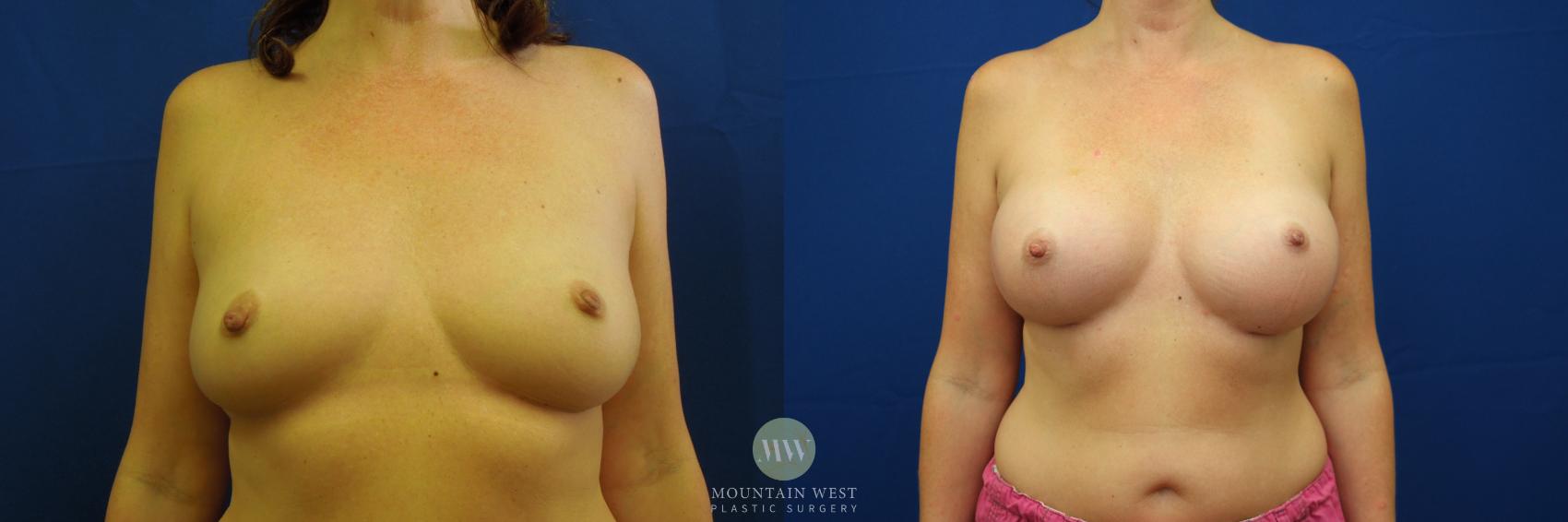 Breast Augmentation Case 31 Before & After View #1 | Kalispell, MT | Mountain West Plastic Surgery