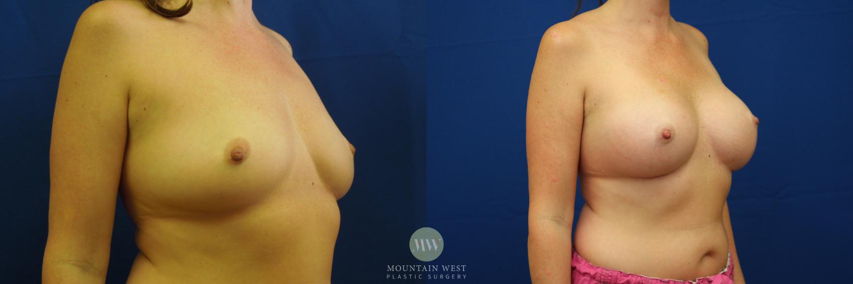 Breast Augmentation Case 31 Before & After View #2 | Kalispell, MT | Mountain West Plastic Surgery