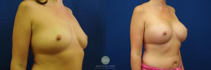 Before & After Breast Augmentation Case 31 View #2 View in Kalispell, MT