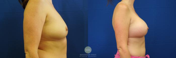 Before & After Breast Augmentation Case 31 View #3 View in Kalispell, MT