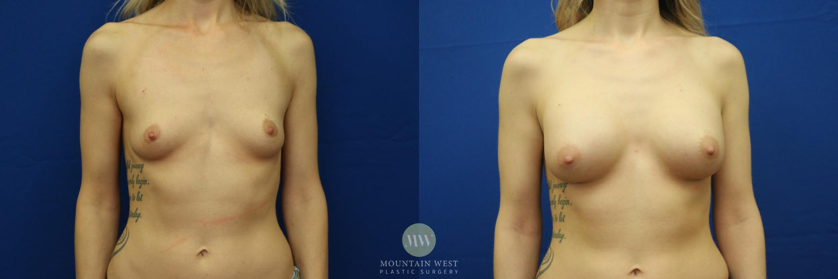 Before & After Breast Augmentation Case 33 View #1 View in Kalispell, MT