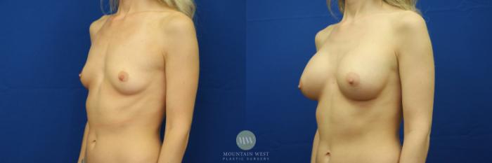 Before & After Breast Augmentation Case 33 View #2 View in Kalispell, MT