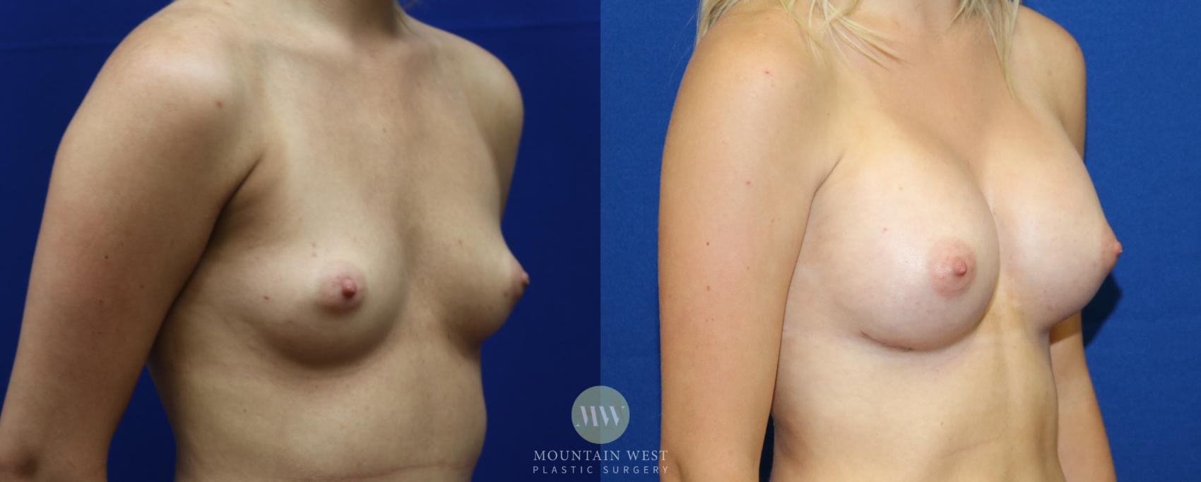 Breast Augmentation Case 39 Before & After View #1 | Kalispell, MT | Mountain West Plastic Surgery