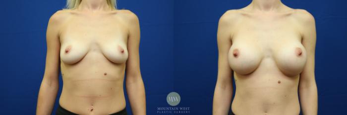 Before & After Breast Augmentation Case 41 View #1 View in Kalispell, MT